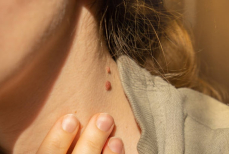 Может ли папиллома превратиться в раковую опухоль