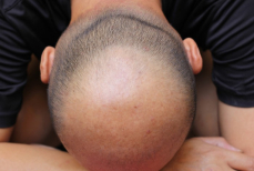 Мужчинам дали совет для восстановления волос при облысении