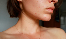 Назван эффективный с древности способ маскировки прыщей