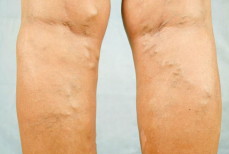 Назван простой способ предотвратить развитие варикоза ног