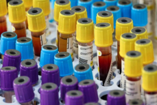 Врач раскрыла, влияет ли курение на результаты анализа крови на сахар