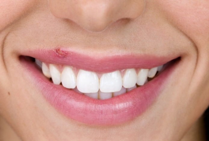 Как быстро убрать герпес на губах