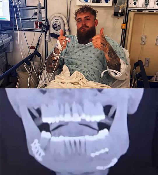 Стало известно состояние Джейка Пола после нокаута от Энтони Джошуа