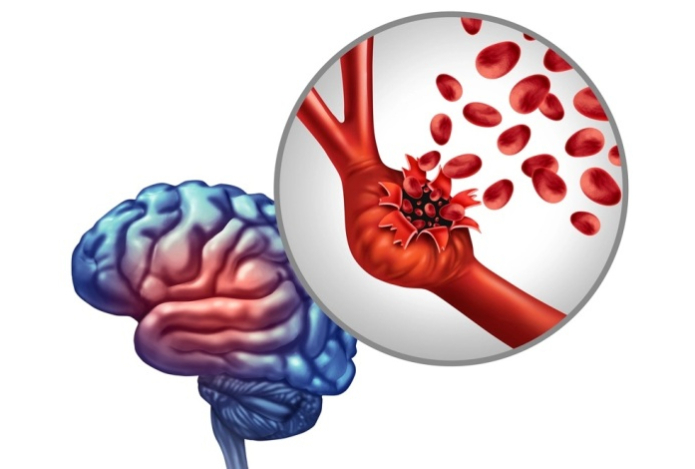 Что такое аневризма и как она появляется