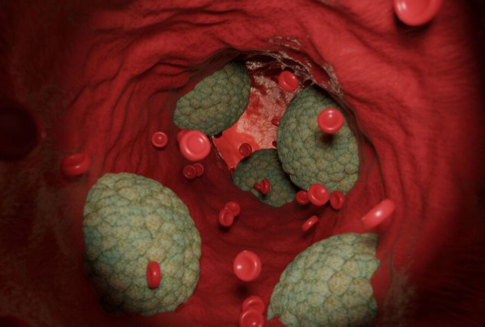 Врач назвал главную причину отложения кальция в сосудах