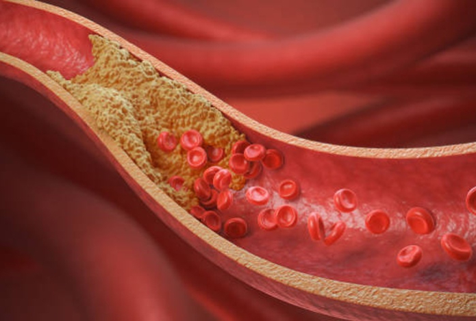 Когда высокий холестерин требует лечения