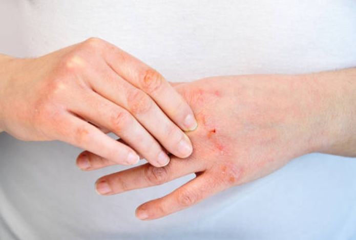 Как защитить кожу в мороз