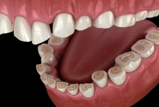 Какая ночная привычка разрушает эмаль зубов