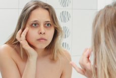 Как избавиться от синяков под глазами?