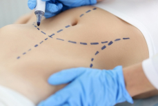 Врач предупредил о страшных последствиях липосакции