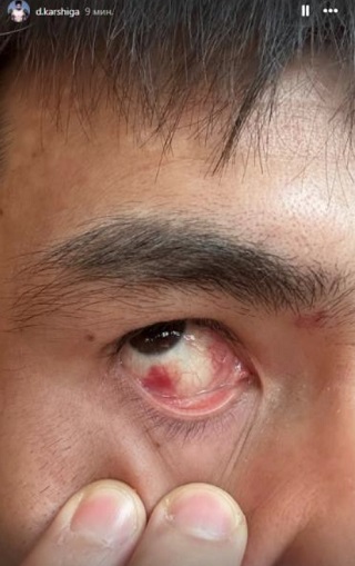 Боец из Казахстана показал последствия тычков в глаз во время поединка в Японии