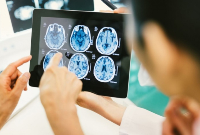 Обнаружена новая связь между диабетом и болезнью Альцгеймера