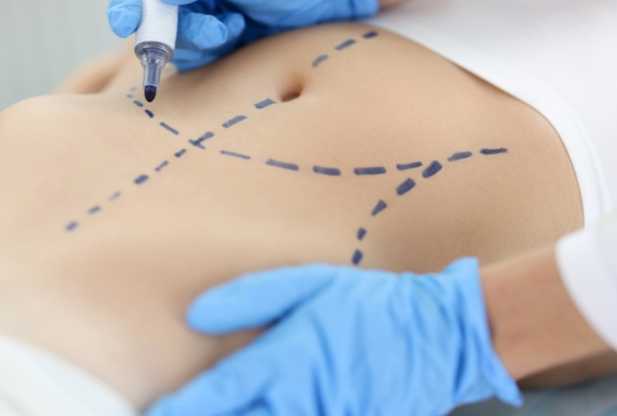 Врач предупредил о страшных последствиях липосакции