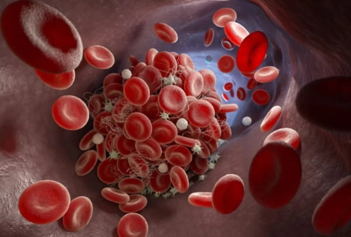 Что означает «оторвался тромб»?