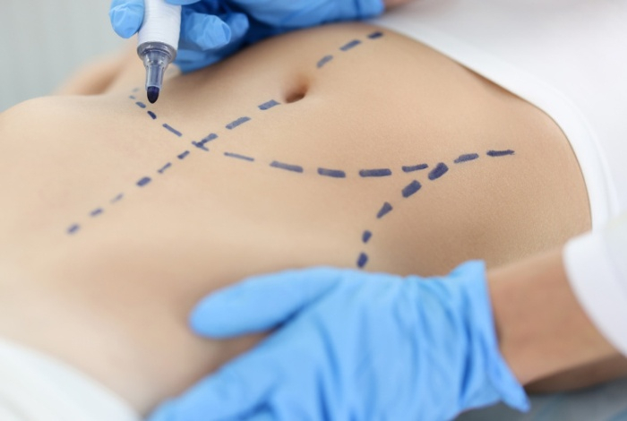 Врач предупредил о страшных последствиях липосакции