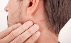 Чем грозит удаление папиллом косметическими средствами с маркетплейсов?