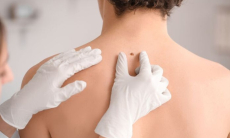 Как может выглядеть рак кожи?