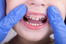 Как связаны больные зубы у детей и частые ангины