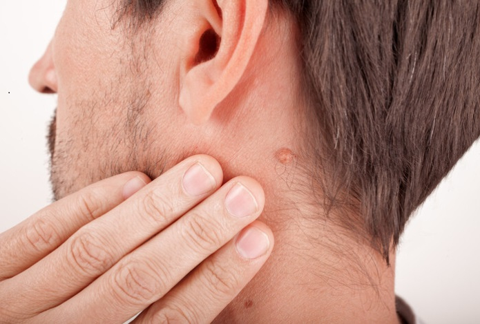 Чем грозит удаление папиллом косметическими средствами с маркетплейсов?