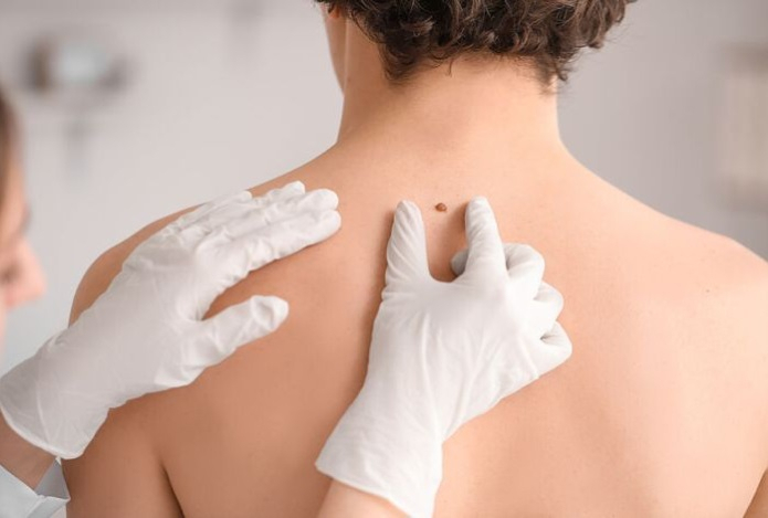 Как может выглядеть рак кожи?