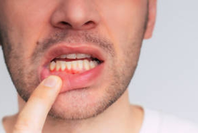 Что может спровоцировать воспаление дёсен