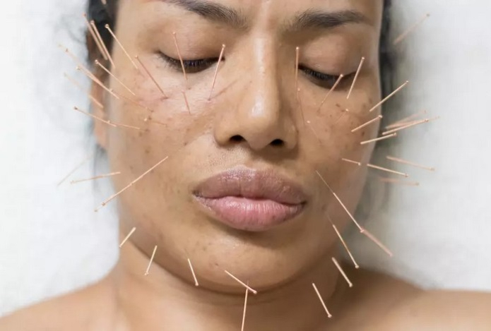 Какие боли может эффективно снять иглоукалывание