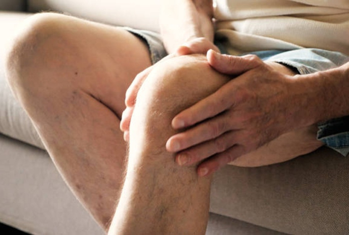 Врач рассказал о современных методах лечения варикоза