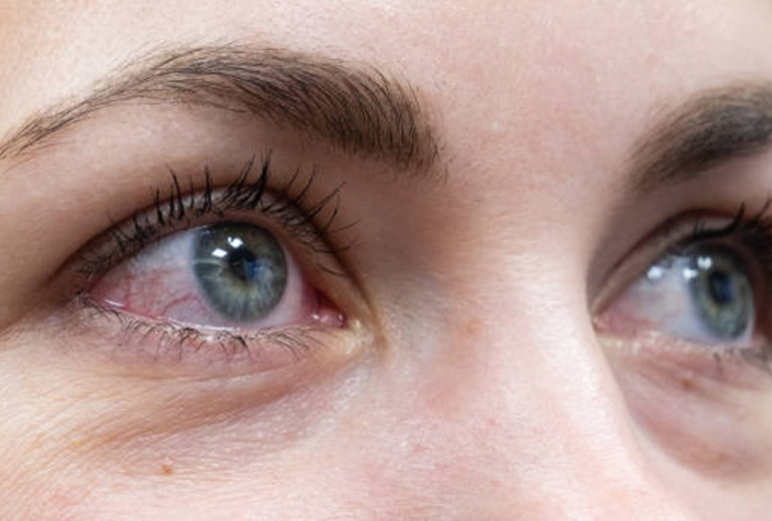 Эксперт рассказала, как помочь покрасневшим глазам после слез