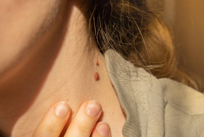 Какие папилломы могут перерасти в рак